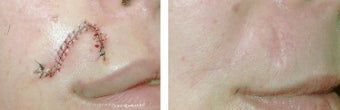MOHS Skin Cancer Surgery before 369216