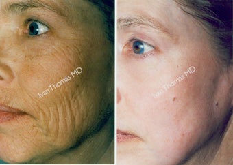 Non-Surgical Face Lift- Exoderm before 242986