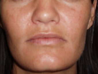 Lip Augmentations before 115571