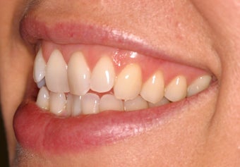 Invisalign before 119943
