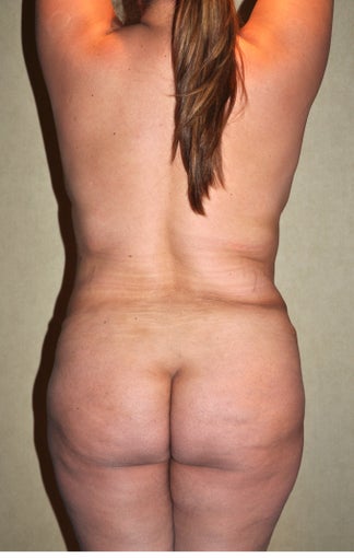 Liposuction after 521677