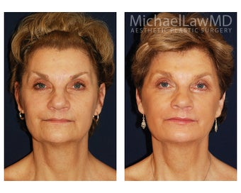 Facial Rejuvenation - Neck Lift before 395452