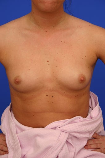 Breast Implants before 415396