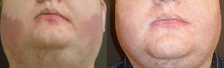 Treatment for port wine stain before 135564