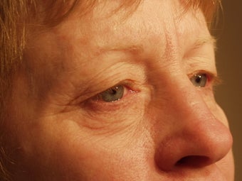 Eyelid surgery with CO2 laser resurfacing before 140083