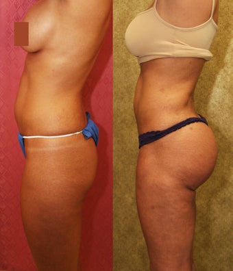 Brazilian Butt Lift 637894