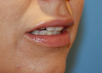 Lip Augmentation after 199329