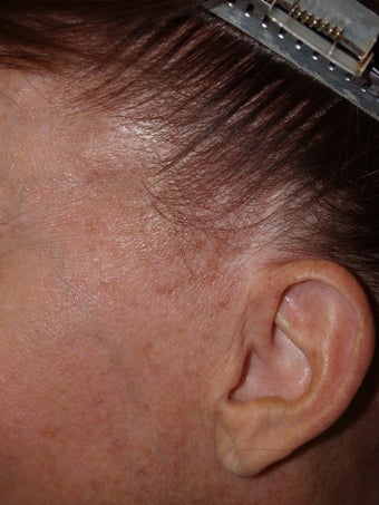 Reconstruction of sideburns with hair transplants lost as a result of prior facelift before 173883