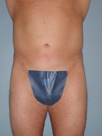 Liposuction after 581412