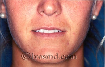 Lip Augmentation before 225580