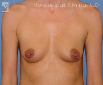 Breast Augmentation before 500539