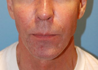 Jaw Augmentation with Implant before 139012