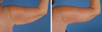 Arm Lift (Brachioplasty) 303695