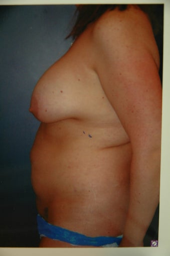 Mommy makeover before 236173