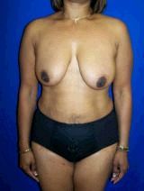 Extended Tummy Tuck with Breast Lift and Implants before 147813
