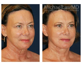 Facial Rejuvenation 395488