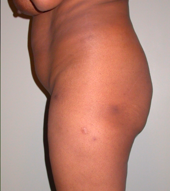 Brazilian Butt Lift before 283333