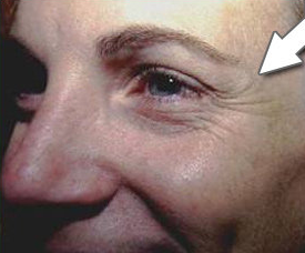 Botox Cosmetic - Crow's Feet before 328095
