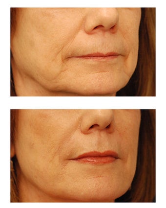 Juvederm before 301154