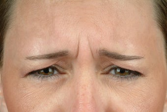 Botox before 531606