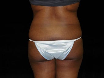 Brazilian Buttocks Lift before 246896