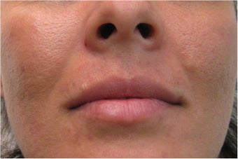 Juvederm for upper lip and nasolabial folds before 77460