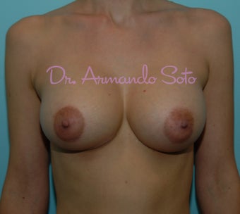 Silicone Implant Breast Augmentation with modified Breast Lift after 188745