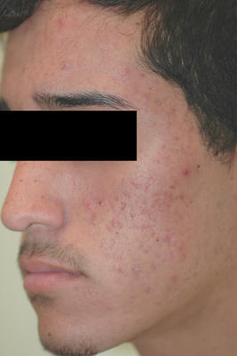 Laser Acne and Acne Scar Treatment after 82968