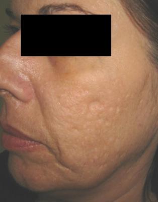 Laser Acne Scar Removal before 82939