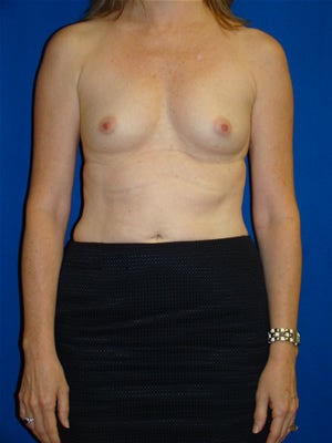 Breast Augmentation Surgery before 111860