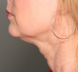 Ultherapy after 582605