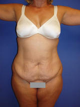 Abdominoplasty surgery before 119463