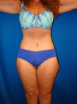 Extended Tummy Tuck, Liposuction, after 495158