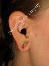 Earlobe Repair Surgery 612308