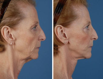 Facelift, upper and lower eyelids, fat injections to face before 253960