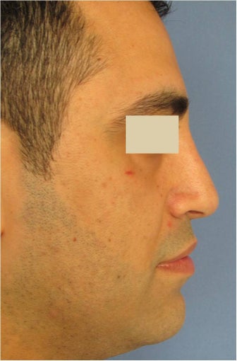 Rhinoplasty, Septoplasty after 125624
