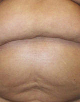 Belly Button after Tummy Tuck Surgery before 123332