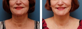 Necklift before 359783