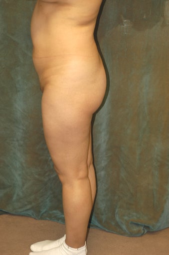 Women's Buttocks Augmentation before 518156
