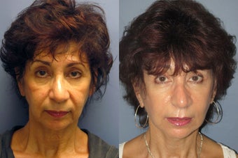 Lite Lift, Brow Lift after 523348