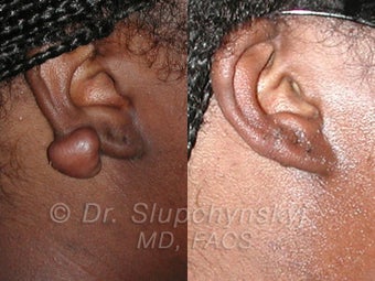 Keloid Removal before 613899