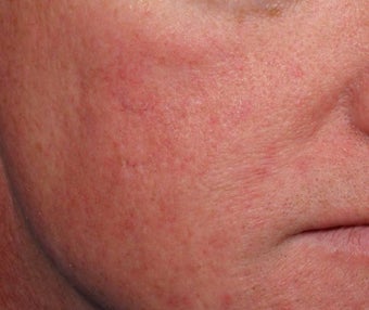 Vein treatment with V Beam after 135896