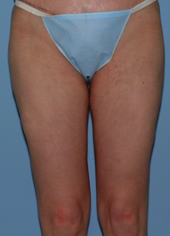 Thigh Lift after 230716