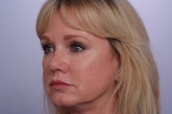 Endoscopic Brow Lift after 250435