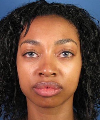 Eyelid Lift Blepharoplasty after 406010
