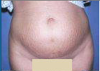 Abdominoplasty before 67003