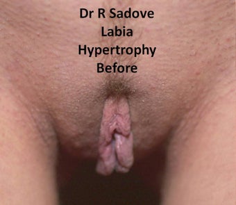 Labia Reduction Double Opposing Skin Flaps before 229459