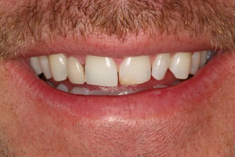 Tooth replacement in the smile before 382033