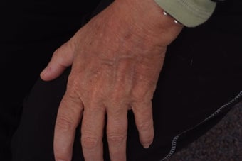 Fractionated CO2 laser resurfacing to hands before 253114