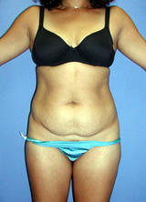 Liposuction Surgery before 123633